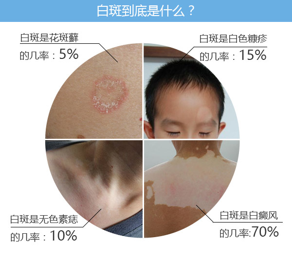 白斑全面的介绍 你分清了吗